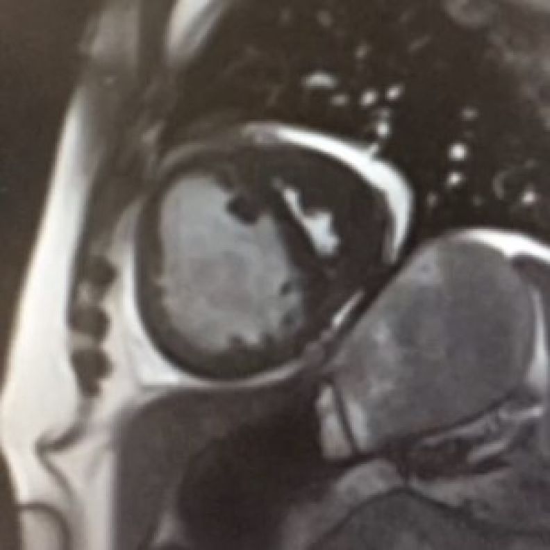 Non-invasive Magnetic Resonance Imaging (MRI) of a cross sectional slice through a human heart of a patient with pulmonary hypertension. Image shows left ventricle (on the left) and right ventricle (on the right)